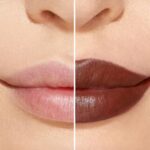 lip filler​